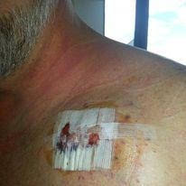 Bandaged shoulder injury with visible bruising.